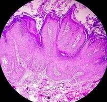 High magnification of skin cells infected with the HPV Virus. Common Wart. Verruca vulgaris. Microscopic view. photo