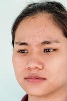 Close up of young Asian woman worry about her face when she has problems with skin on her face. Problems with acne and scar on the female skin. Problem skincare and health concept. photo