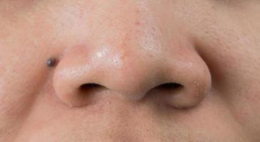Blackheads acne on Asian woman nose. Scar on tip of nose. Open comedones and large pores skin need AHA, BHA or benzoyl peroxide for treatment. photo