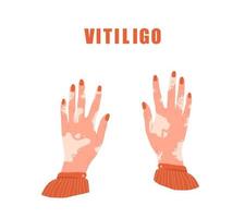 Female hands with vitiligo. World vitiligo day. Skin disease. Self care and self love. Vector illustration in flat cartoon style