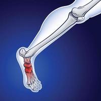 An illustration of a running skeletal line showing a red dot indicating an injury. vector