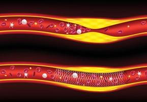Las ilustraciones 3D antes y después de la colocación de stents mejoran el flujo sanguíneo, la aterosclerosis. vector