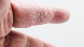 Zeigefinger-Hautkrankheit auf weißem Hintergrund video
