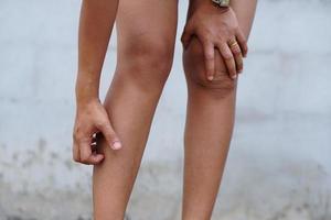 Woman wearing shorts itchy legs Scratch with your hands to relieve itching. photo