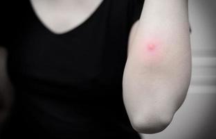 The inflammation of the swelling from abscess near woman elbow. Selective focus. Black and white tone photo