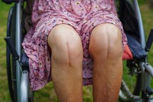 Asian elderly woman patient with scar knee replacement surgery in hospital. photo