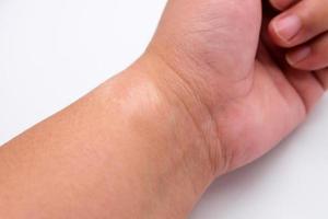 Close-up of a scar on a left wrist with white background