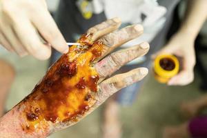 Applying medicine to treat burns on the hands. treating burns on male's hand. photo