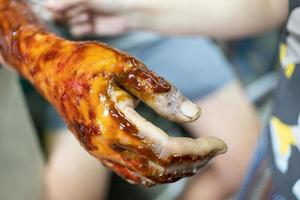 Applying medicine to treat burns on the hands. treating burns on male's hand. photo