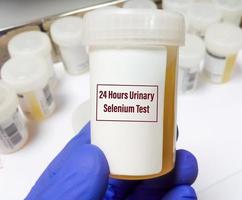 Laboratory scientist hand hold urine container with sample for 24 hours urinary selenium test. photo