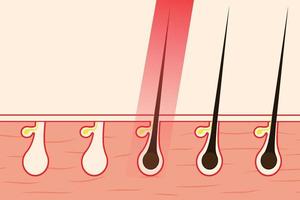 Hair Removal Vector Art, Icons, and Graphics for Free Download Hair Removal Vector Art, Icons, and Graphics for Free Download