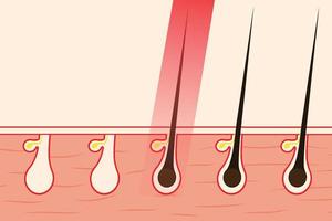 eliminar el vello con la ilustración del vector de luz láser roja. eliminar el vello corporal desde la raíz del cabello mediante el uso de un tratamiento con láser. salón de belleza trabaja información y vector de concepto de depilación.