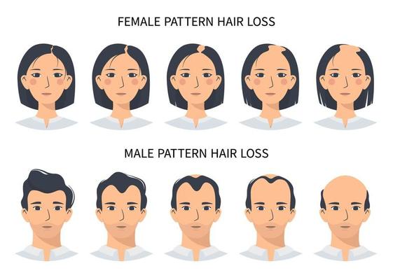 Hair loss stages, androgenetic alopecia male and female pattern. Steps of  baldness vector infographic in a flat style with a man and a woman.  Changing the hairline on the scalp 8028340 Vector