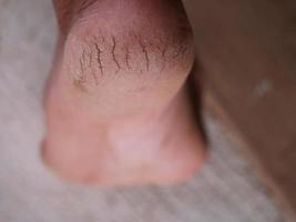 Cracked heels can be used to illustrate health problems. photo