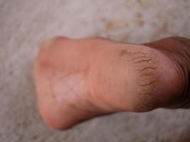 Cracked heels can be used to illustrate health problems. photo