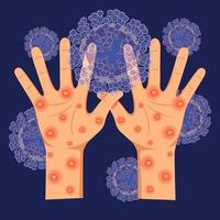 Human hands with monkeypox virus on the microscopic background of the virus. Vector illustration of monkeypox. Skin infection. Virus symptoms.