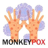 Monkeypox virus. Human hands with a rash on a microbiological background with text. Monkeypox concept. Vector illustration.