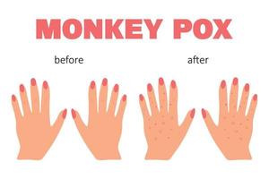 Banner with smallpox monkey. Monkey pox. Hands with a rash. Smallpox symptom. Vector illustration.