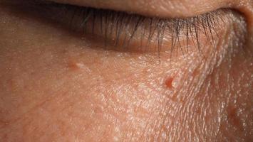 Wart skin removal. Macro shot of warts near eye on face. photo