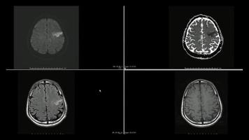 Magnetic resonance  images ,MRI, of brain infarction  in the left frontal lobe superior cuts photo