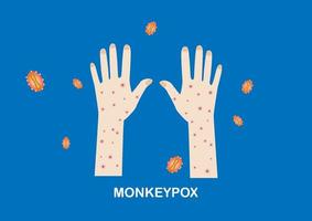 Illustration of rashes on hands and monkeypox viruses vector