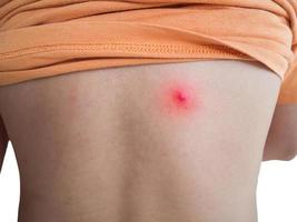 Young man with acne, with red spots on the back photo