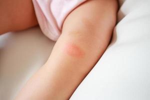 baby skin rash and allergy with red spot cause by mosquito bite at knee photo