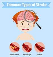 humano con tipos comunes de accidente cerebrovascular vector