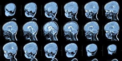 resonancia magnética del cráneo y el cerebro humanos, con malformaciones del cerebro, diagnóstico preliminar, holoproencefalia, ausencia, agenesia del tabique transparente, niño de un año, vista lateral. foto