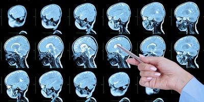 Doctor's hand points to a set of MRI scans of the human skull and brain, with cerebral malformations, preliminary diagnosis, holoproencephaly, absence, agenesis of the transparent septum, side view. photo