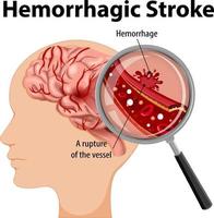 humano con accidente cerebrovascular hemorrágico vector