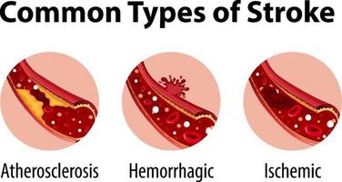 Infographic of common types of stroke vector