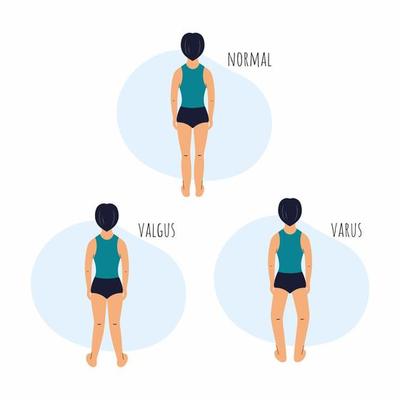 Boy with curvature legs. Health problem. Valgus and varus feet.