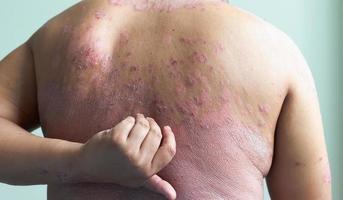 Patients are using their own hands, scratching themselves full of inflammatory lesions photo