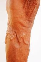 The severity of the varicose veins ranges from the tiny capillaries, pain in the legs, swollen feet and legs, and the crooked aneurysm resembles a worm. photo