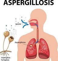Diagram showing aspergillus infection vector