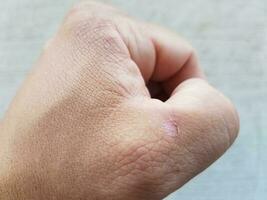 man's fist with blister near thumb photo