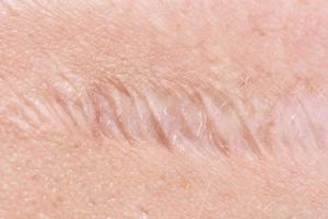 scar on the skin photo