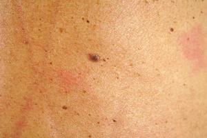 Moles on the back of human skin photo