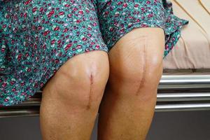 Asian elderly woman patient with scar knee replacement surgery in hospital. photo