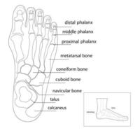 bursitis en los lados del pie. el hueso y la piel a los lados de la articulación del dedo gordo del pie forman una forma anormal del pie. problema comun. vector