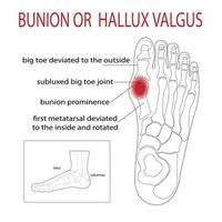 Bursitis on the sides of the foot. The bone and skin on the sides of the big toe joint form an abnormal foot shape. Common problem. vector