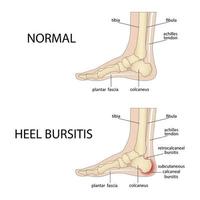 bursitis del calcáneo. pie con talón normal y pie con deformidad de Haglund y bursitis. vector