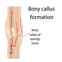 Stage of healing of bone fractures. callus formation. Hematoma. Crack in the bone. Infographics. Final illustration on isolated background. vector