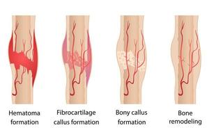 Etapas de curación de las fracturas óseas. vector