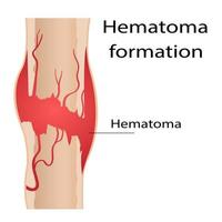 Stage of healing of bone fractures. callus formation. Hematoma. Crack in the bone. Infographics. Final illustration on isolated background. vector