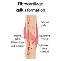 Stage of healing of bone fractures. callus formation. Hematoma. Crack in the bone. Infographics. Final illustration on isolated background. vector