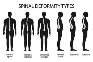 Spine deformity vector illustration. Kyphosis, lordosis spine infographic. Diagram with spine curvature and healthy spine. Posture defect. Medical, educational and scientific banner.