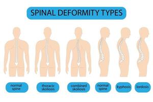 Spine deformity vector illustration. Kyphosis, lordosis spine infographic. Diagram with spine curvature and healthy spine. Posture defect. Medical, educational and scientific banner.
