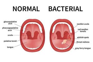 amigdalitis bacteriana y viral. angina, faringitis y amigdalitis. infección de amígdalas boca abierta. vector